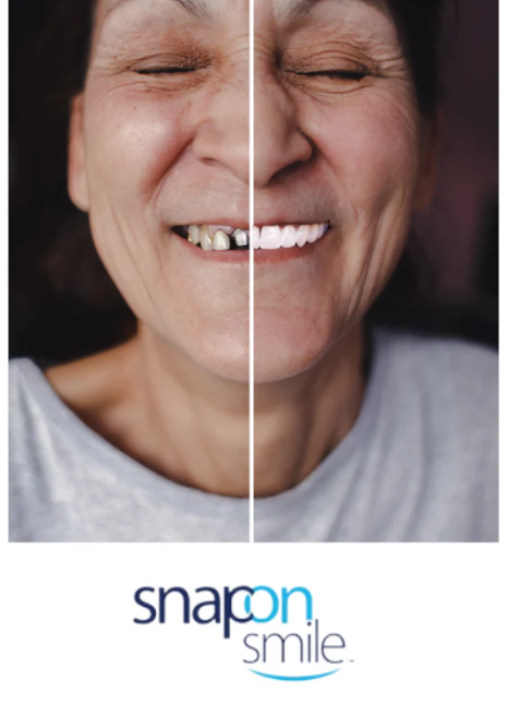 SNAP ON SMILE-LUCE UNOS DIENTES PERFECTOS EN MINUTOS