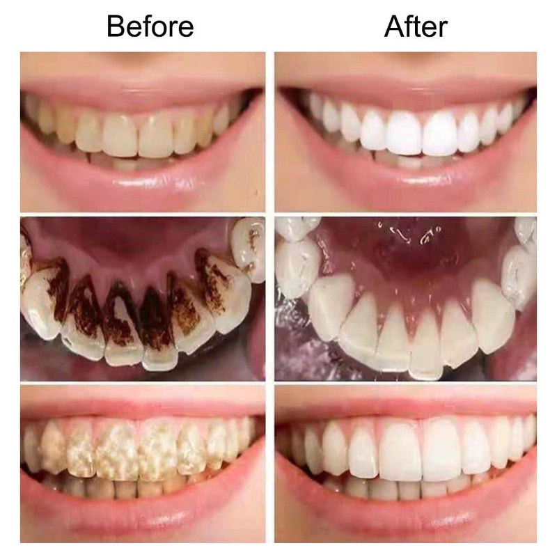 Clareador de Dentes e Removedor de Manchas